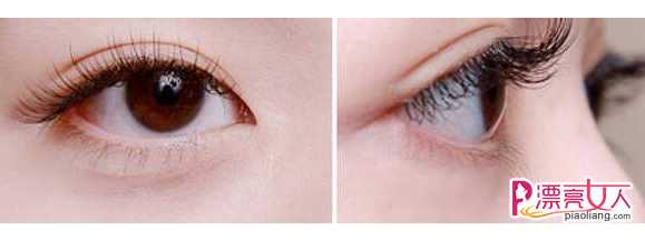  睫毛种植会影响眼睛发炎吗?