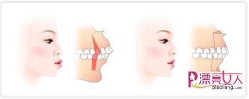  什么是嘴巴突出？突嘴手术方法有几种？
