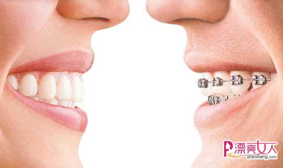  成年人牙齿矫正需要多长时间?