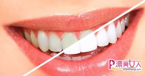  牙齿贴面的种类有哪些？
