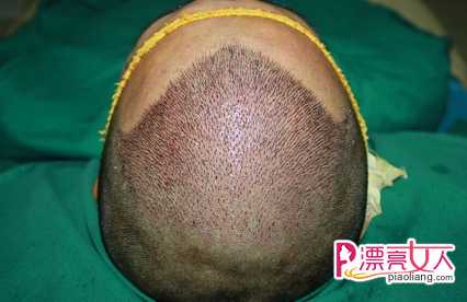  植发手术 完美解决头上疤痕