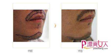  胡须种植术：一张图看出胡子对男人的重要性