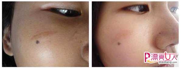  脸部疤痕修复前后对比照  面部疤痕修复手术方法