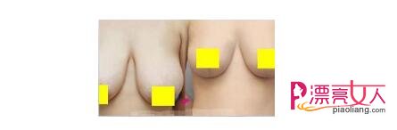  乳房下垂怎么丰胸？为你重塑女人魅力!