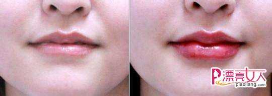  唇珠成形术后会造成口腔感染吗？