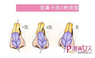  韩国歪鼻矫正过程示意图 真人效果对比图