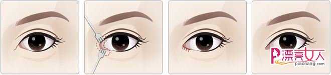  开内眼角后疤痕增生怎么办？如何预防疤痕增生？