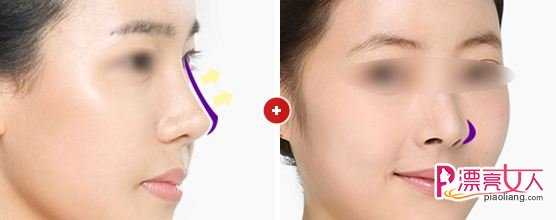  鼻尖整形手术前有那些注意事项?化妆会影响吗？