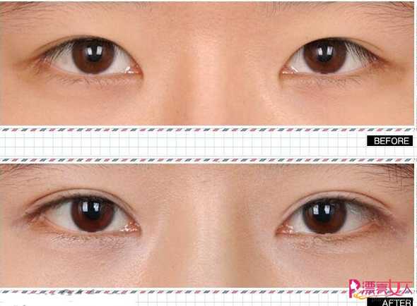  哪种双眼皮的类型适合你 不同脸型适应不同眼皮