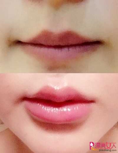  丰唇后多久可以擦口红?玻尿酸丰唇的优势有哪些?