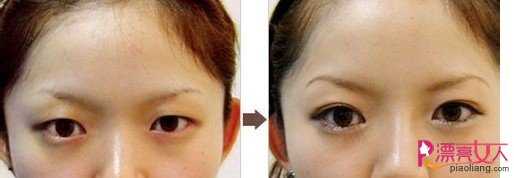  割双眼皮有什么坏处?如何预防割双眼皮后出现的疤痕