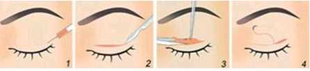  怎么割成双眼皮 图解3种不同的手术方式