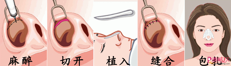  隆鼻不仅仅是胶体植入 总有一种类型适合你