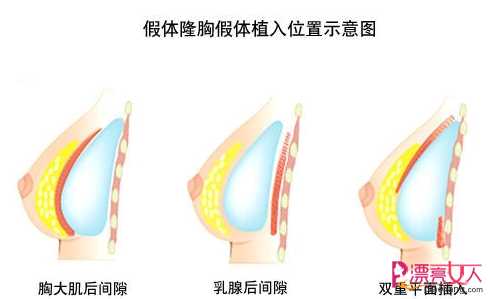  隆胸新概念：韩式水滴型胸部