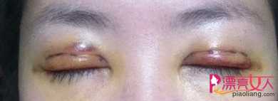  割双眼皮的经历 割双眼皮的前后对比图片