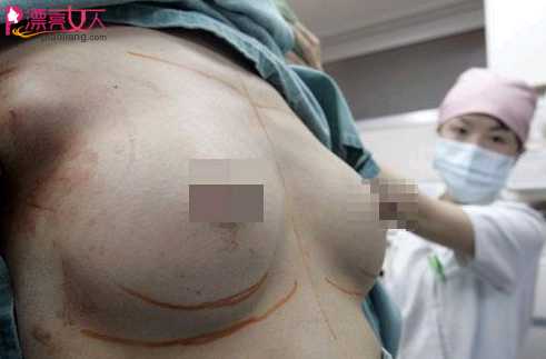  惊悚！实拍日本美女隆胸手术全过程