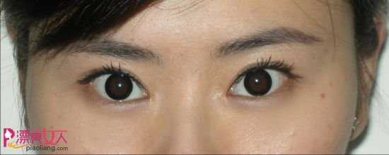  直击双眼皮手术 看美眉如何告别单眼皮
