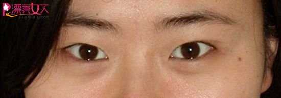 直击双眼皮手术 看美眉如何告别单眼皮