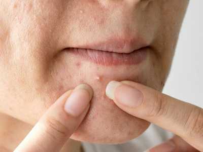  嘴角长痘是什么原因？怎么调理？