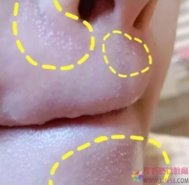  脸上为什么会长白色的小颗粒？如何防止脸上长白色的小颗粒？