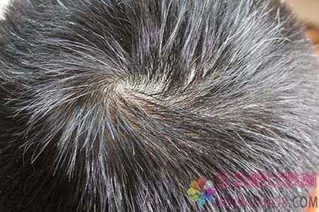  头发白了原因和如何避免增加数量？3种方法防止白头发